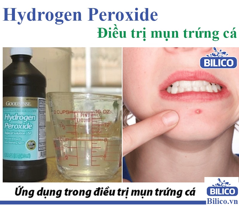 Hydrogen Peroxide để điều trị mụn